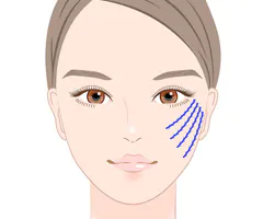 R式糸リフト