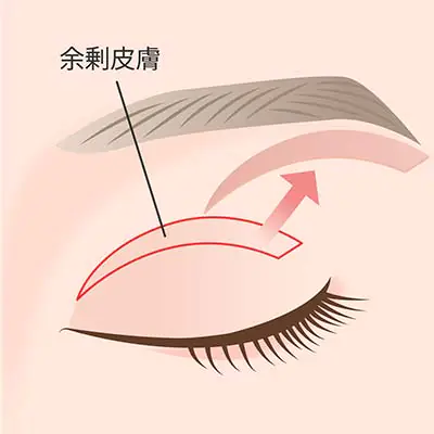⼆重整形 （切開法）