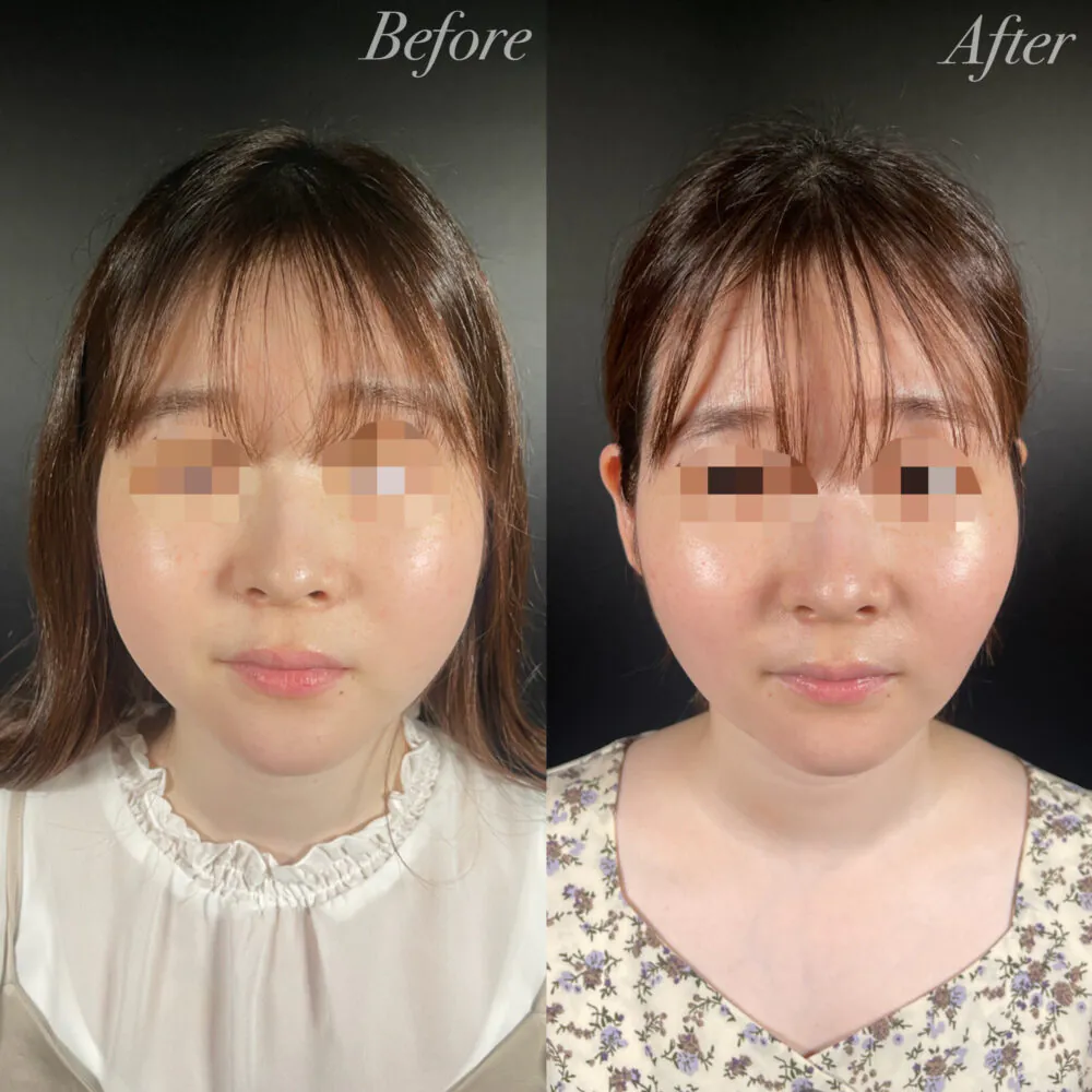 人気のバッカルファット手術で失敗する人とは？ ✅セルフチェック診断付き