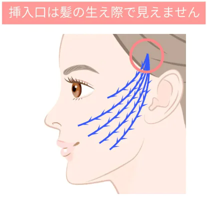 糸によるリフトアップ、何本が正解？