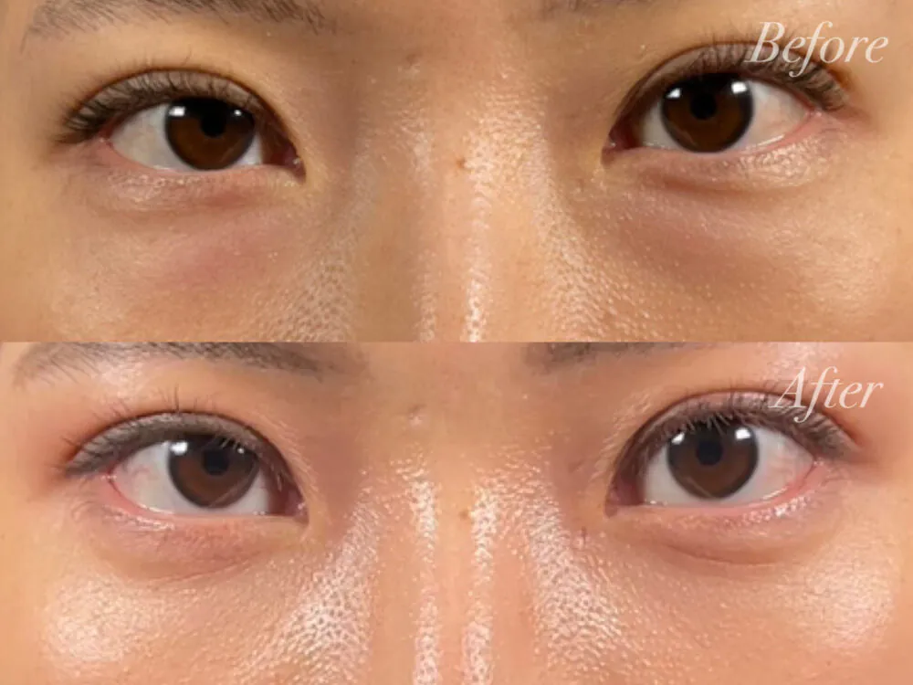 目の下のふくらみ取りの適応って？？