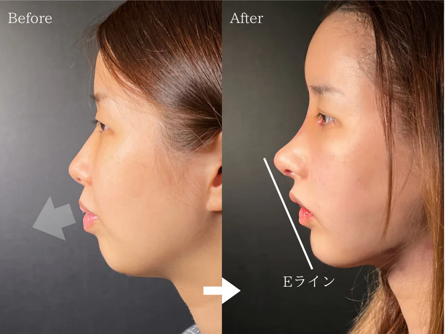 切らずに「口ゴボ」を治療して横顔美人になる方法