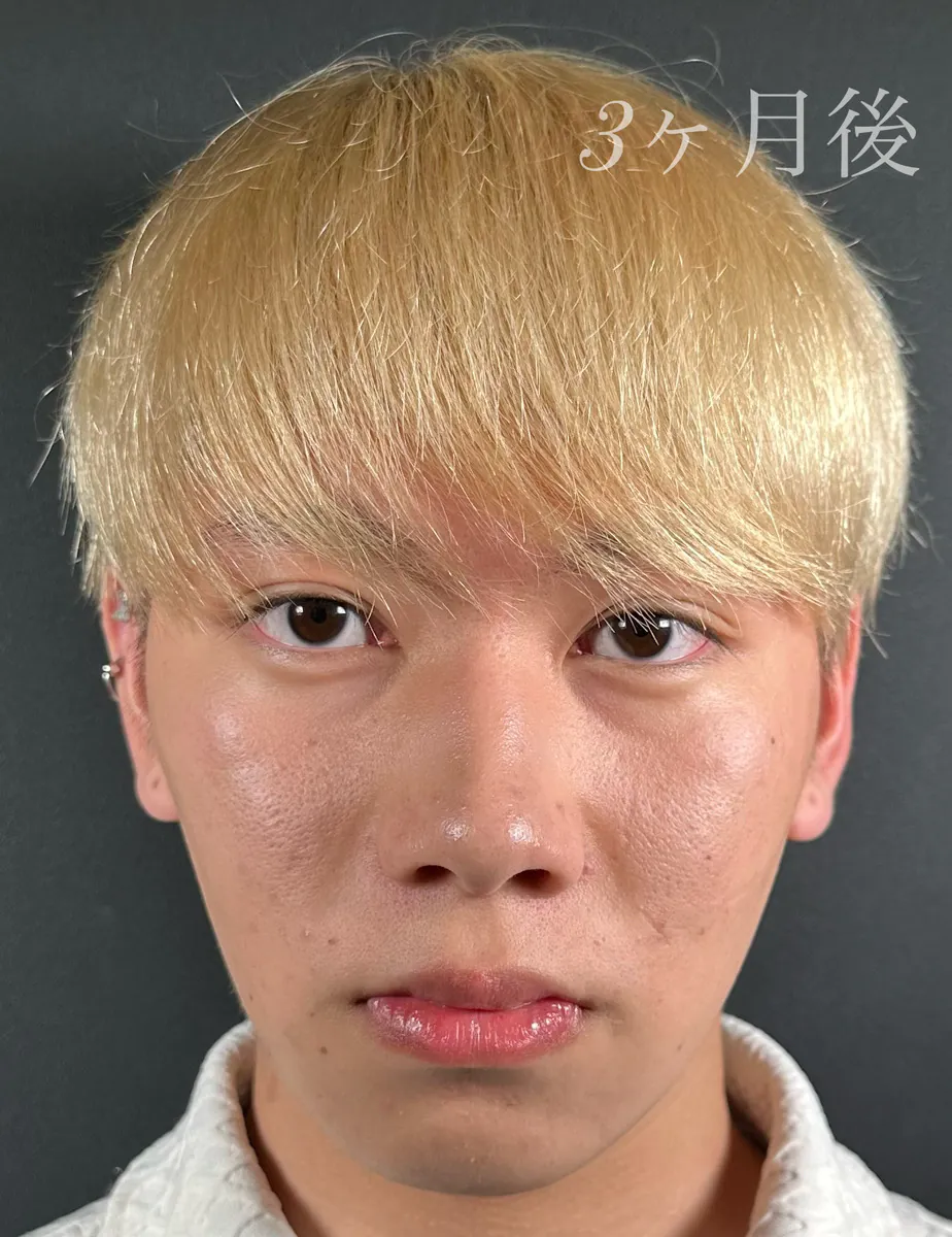 男性の顔の脂肪吸引は増えているの？