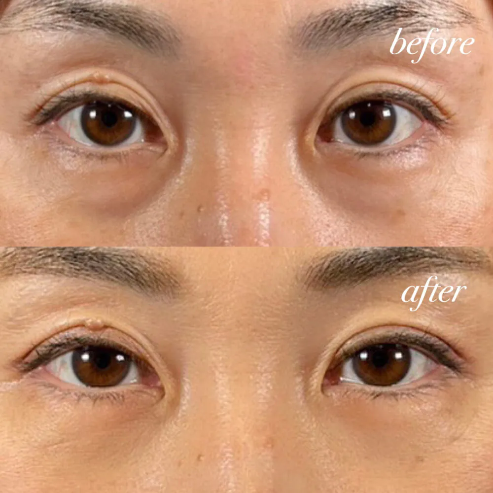 ハムラ法、表と裏の違いは？