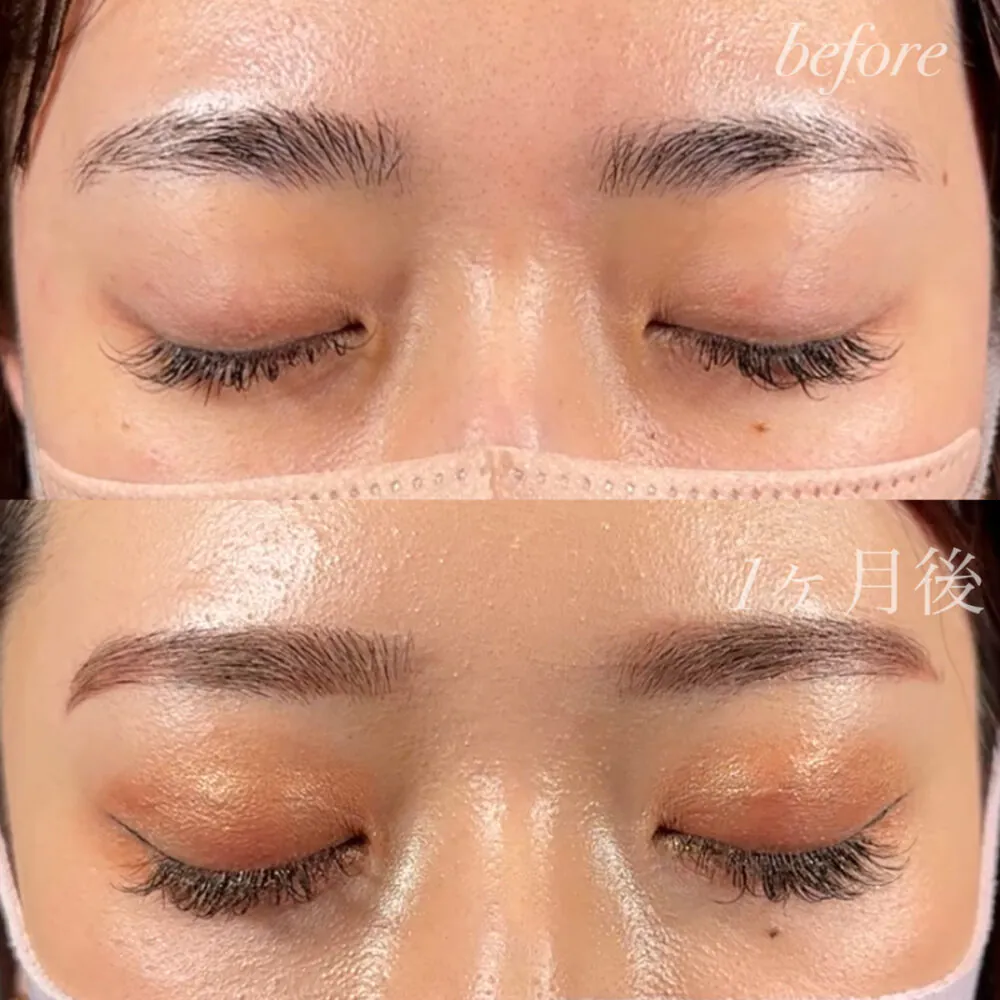 二重埋没の幅は何mmが理想的？