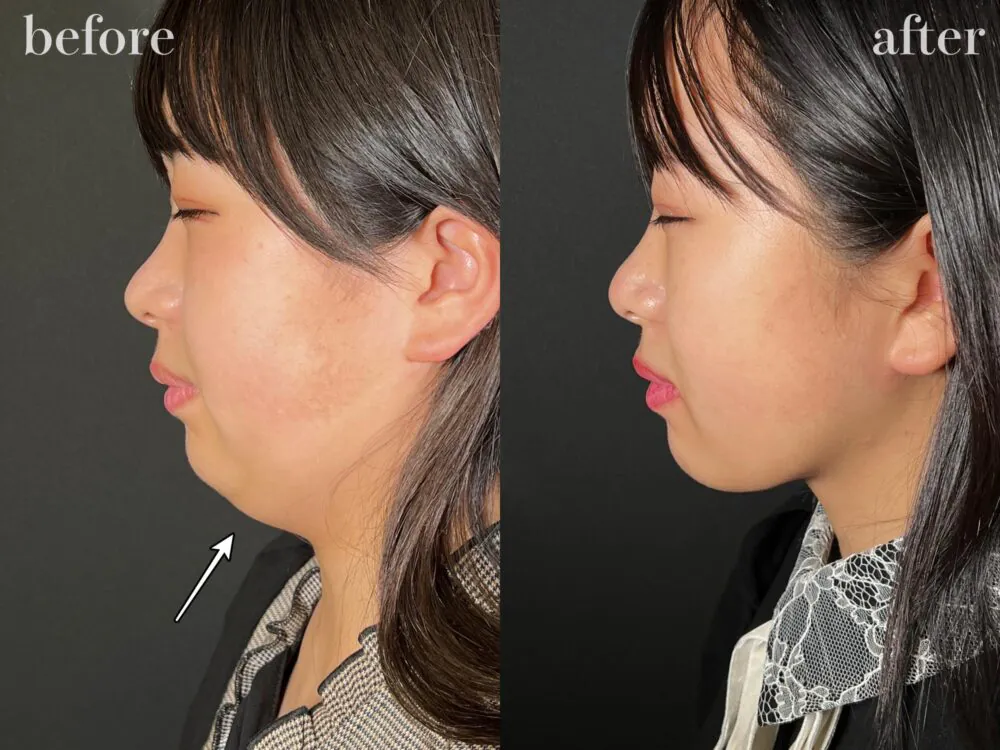 顔の脂肪吸引をしてみたい！カウンセリングから手術後まで流れを解説