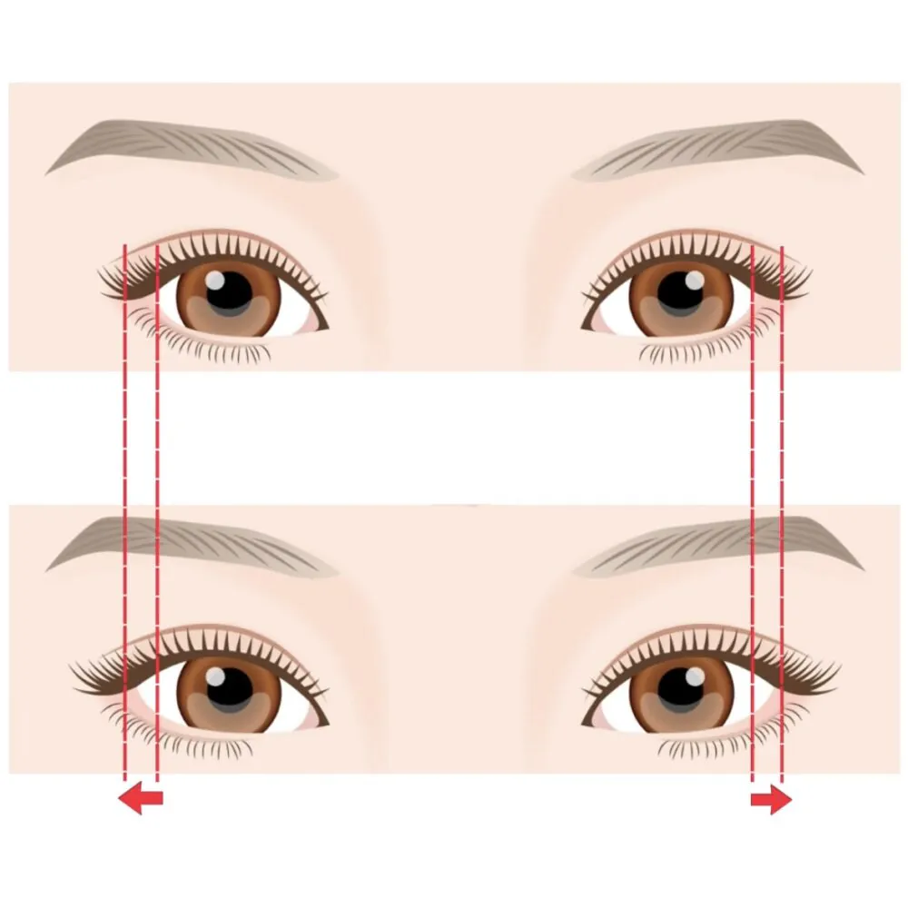 目尻切開で目は大きくなるの！？当院の目尻切開の方法