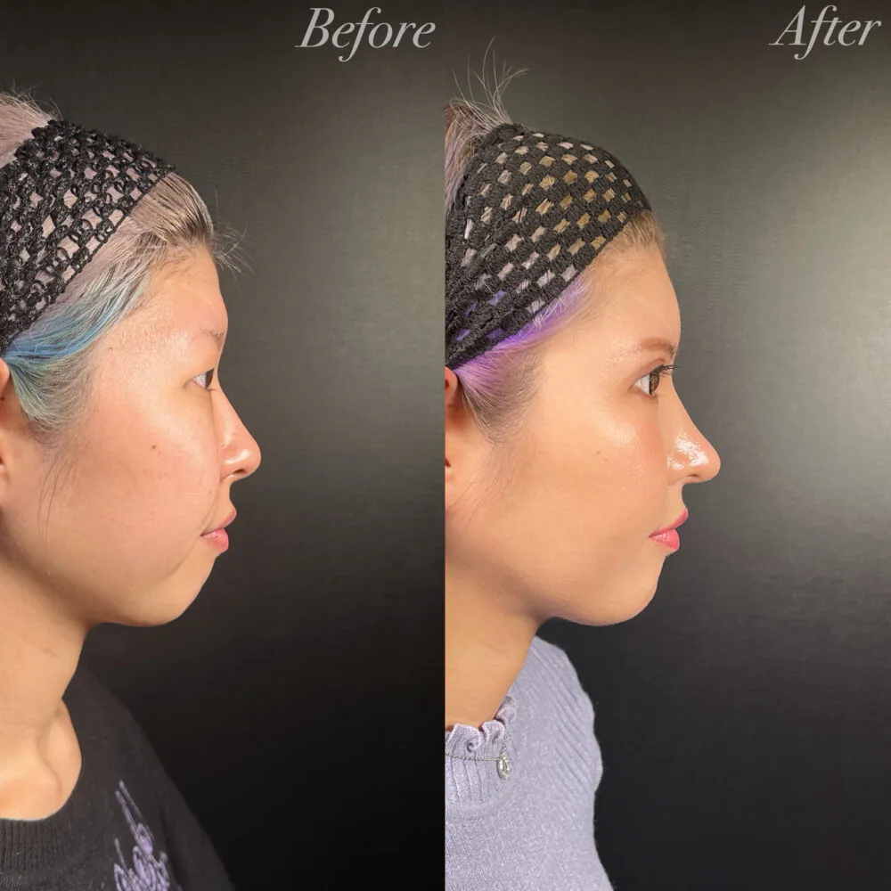 鼻整形症例モニター例