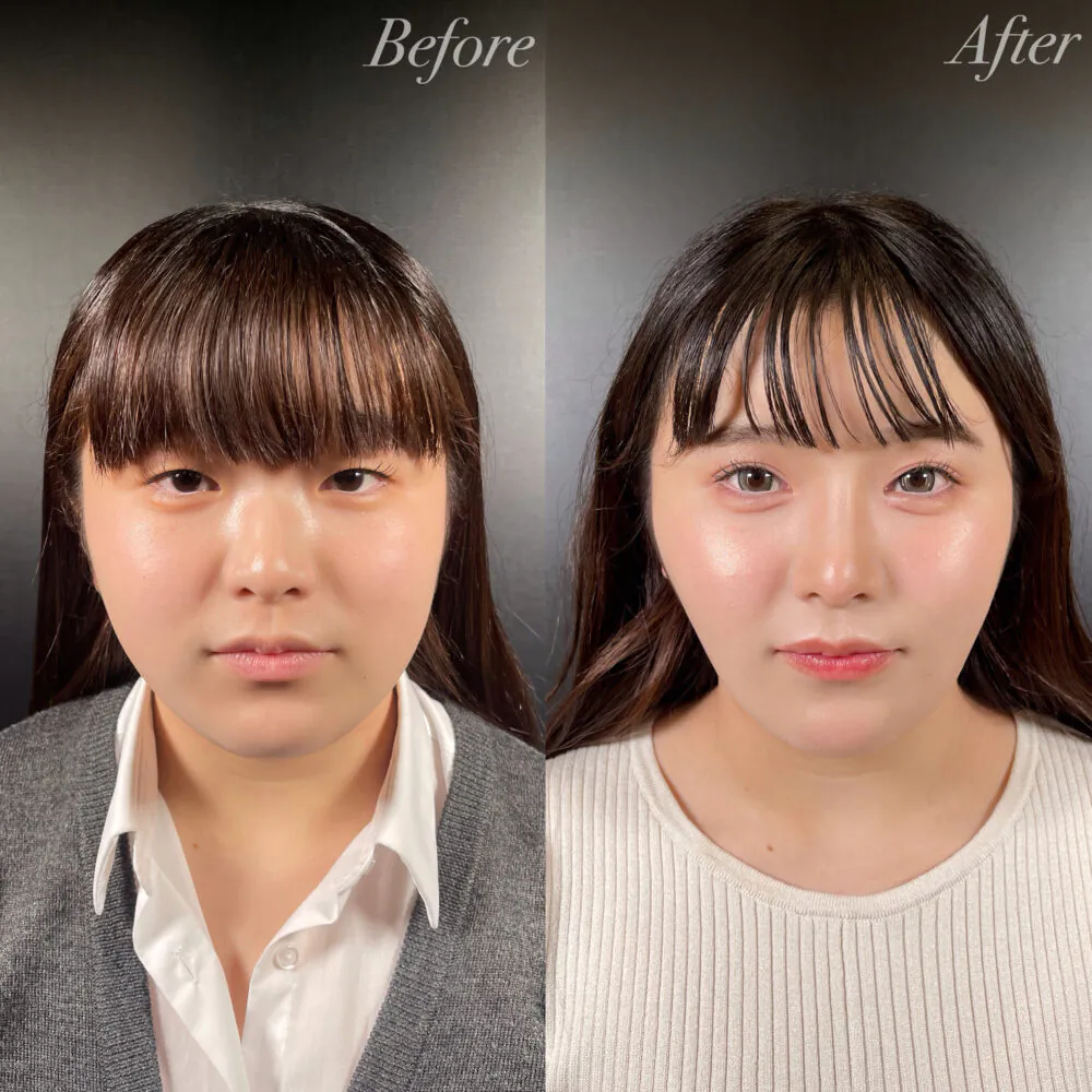 二重整形症例モニター例