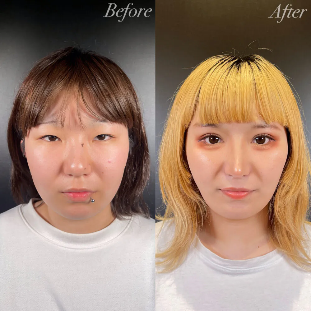 二重整形症例モニター例