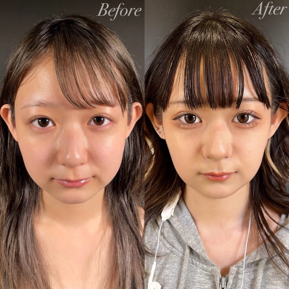 二重整形症例モニター例