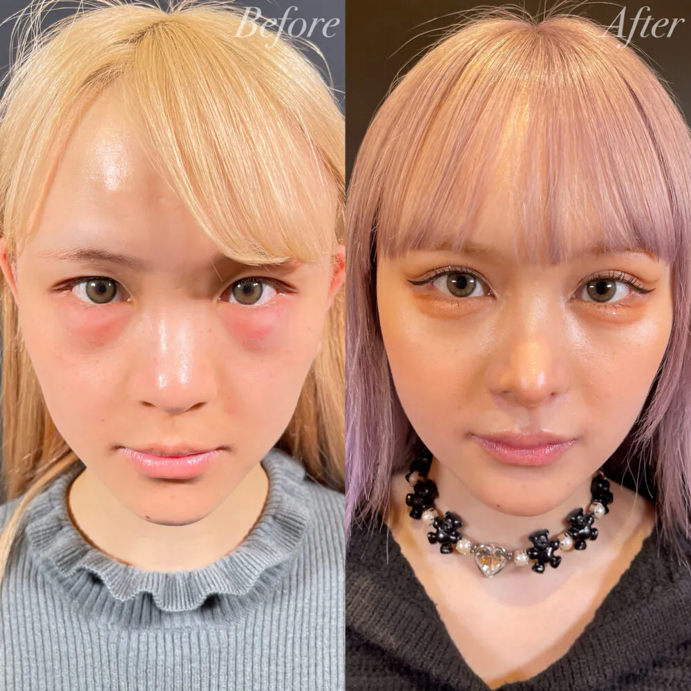 二重整形症例モニター例