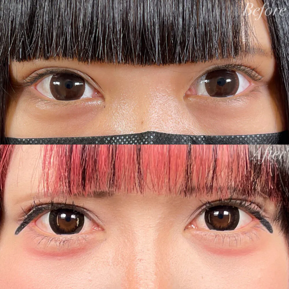 二重整形症例モニター例