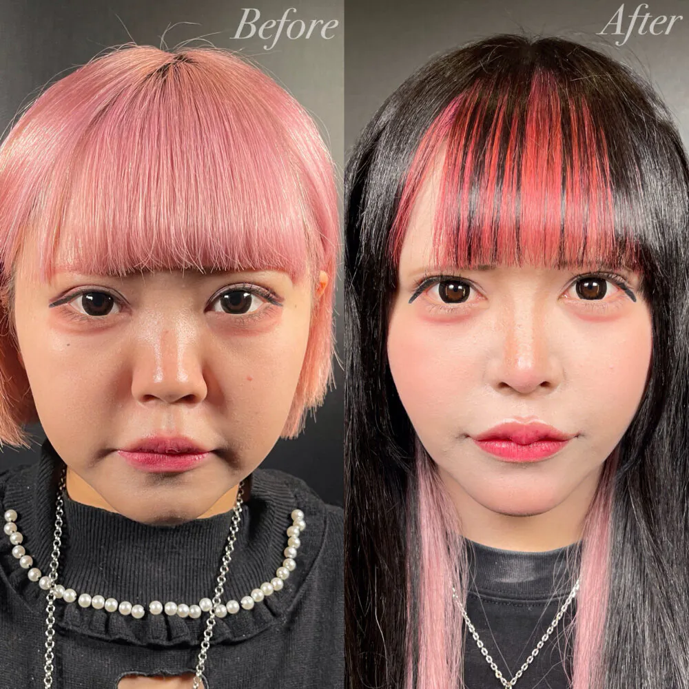 二重整形症例モニター例