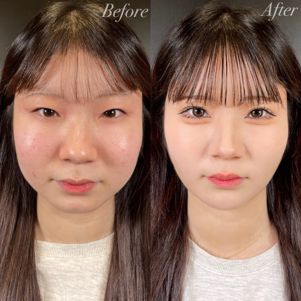 二重整形症例モニター例