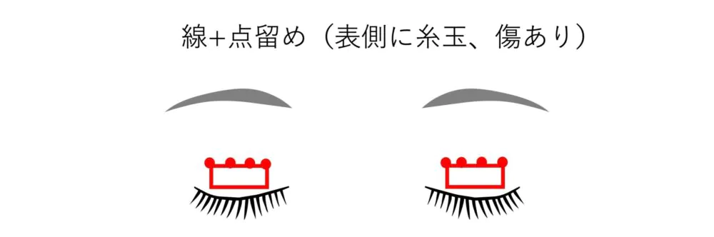 二重埋没法「挙筋法」と「瞼板法」の違いとは？「線留め」と「点留め」の違いは？